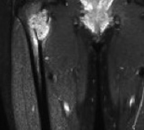 MRI Ewings Sarcoma Proximal Femur